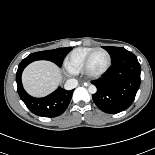File:Adhesional small bowel obstruction (Radiopaedia 52107-57980 Axial C+ portal venous phase 5).jpg