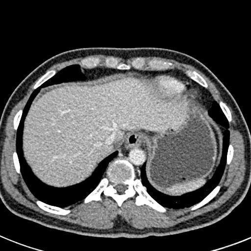Adhesional small bowel obstruction (Radiopaedia 58900-66131 Axial C+ portal venous phase 6).jpg