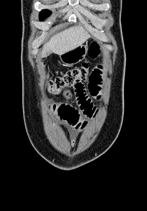 Adhesional small bowel obstruction (Radiopaedia 58900-66131 Coronal C+ portal venous phase 69).jpg