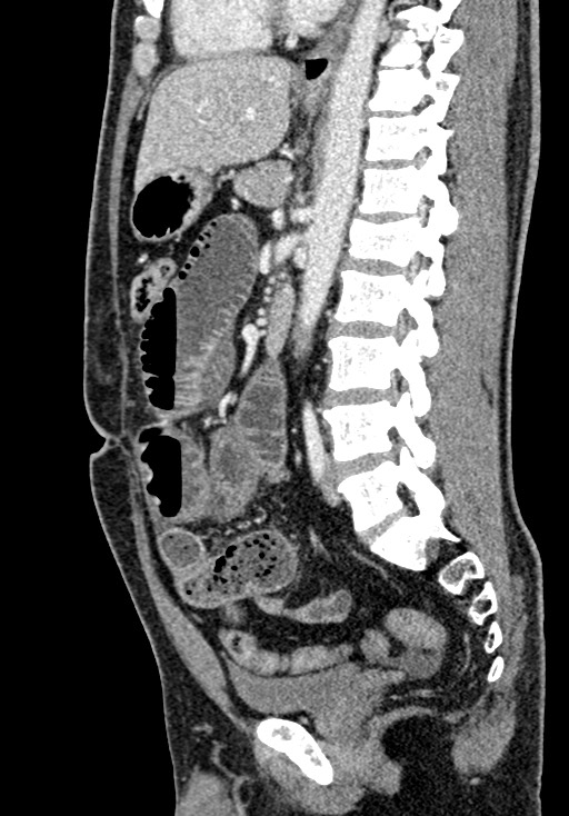Adhesional small bowel obstruction (Radiopaedia 58900-66131 Sagittal C+ portal venous phase 137).jpg