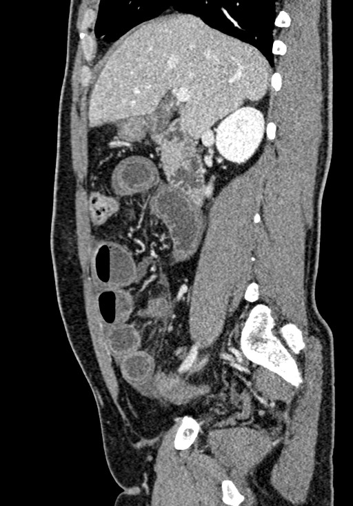 Adhesional small bowel obstruction (Radiopaedia 58900-66131 Sagittal C+ portal venous phase 92).jpg