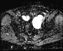 File:Adnexal multilocular cyst (O-RADS US 3. O-RADS MRI 3) (Radiopaedia 87426-103754 Axial 157).jpeg