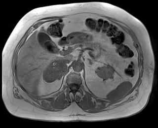 File:Adrenal cortical carcinoma (Radiopaedia 64017-72770 Axial T1 in-phase 26).jpg