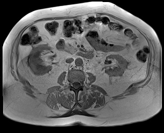 File:Adrenal cortical carcinoma (Radiopaedia 64017-72770 Axial T1 in-phase 48).jpg
