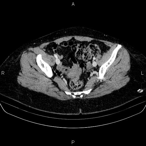 Adrenal cortical carcinoma (Radiopaedia 84882-100379 Axial C+ portal venous phase 82).jpg
