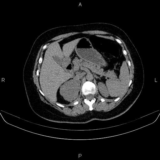 File:Adrenal cortical carcinoma (Radiopaedia 84882-100379 Axial non-contrast 27).jpg