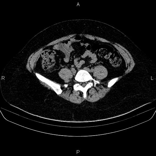 File:Adrenal cortical carcinoma (Radiopaedia 84882-100379 Axial non-contrast 63).jpg