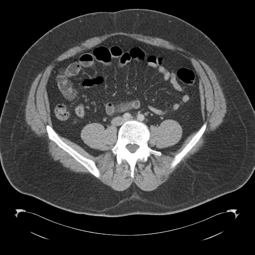 Adrenal cyst (Radiopaedia 45625-49776 Axial C+ portal venous phase 63).png