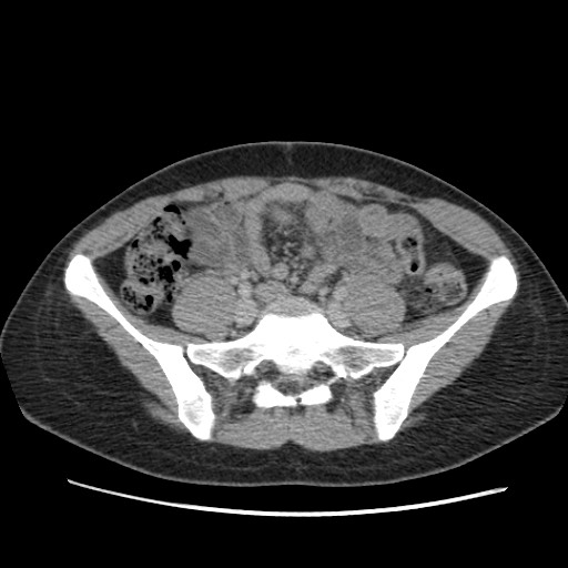 Adrenal cyst (Radiopaedia 64869-73813 Axial C+ portal venous phase 54).jpg