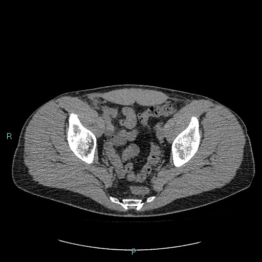 Adrenal cystic lymphangioma (Radiopaedia 83161-97534 Axial non-contrast 86).jpg