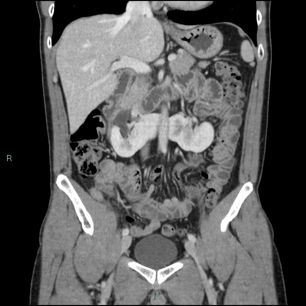 File:Adrenal cystic lymphangioma (Radiopaedia 83161-97534 Coronal C+ portal venous phase 32).jpg
