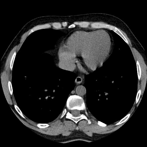 Adrenal gland trauma (Radiopaedia 81351-95079 Axial non-contrast 3).jpg