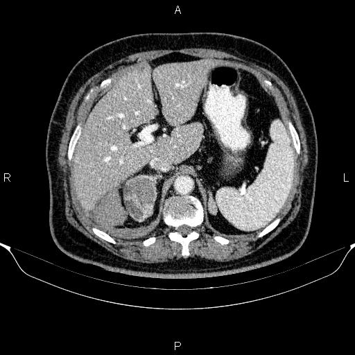 Adrenal hemorrhage (Radiopaedia 62622-70916 Axial C+ portal venous phase 42).jpg