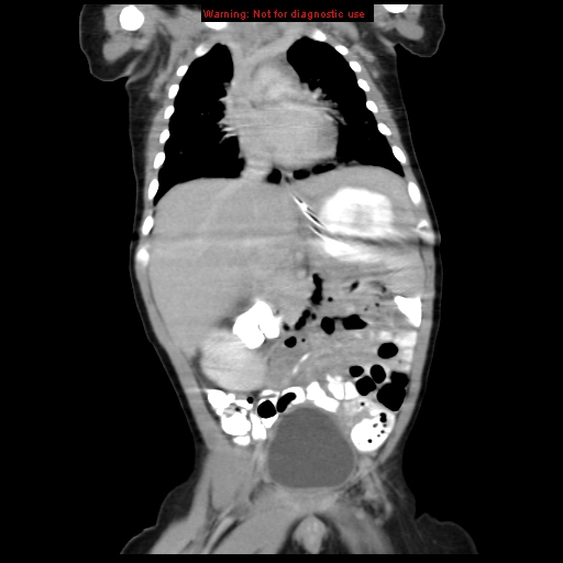 File:Adrenal hemorrhage (Radiopaedia 9390-10077 Coronal C+ portal venous phase 3).jpg