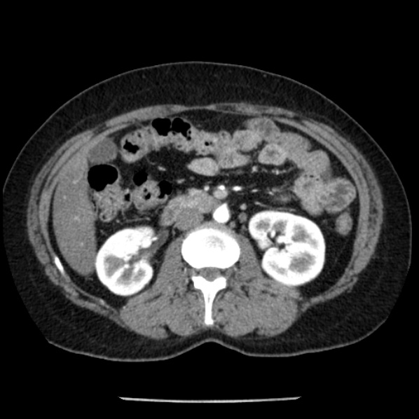 Adrenal myelolipoma (Radiopaedia 43401-46759 Axial C+ arterial phase 47).jpg