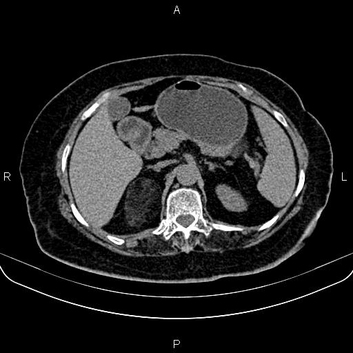 Adrenal myelolipoma (Radiopaedia 82742-96986 Axial non-contrast 44).jpg