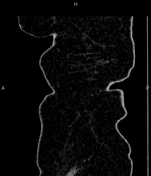 Adrenal myelolipoma (Radiopaedia 82742-96986 Sagittal renal cortical phase 106).jpg