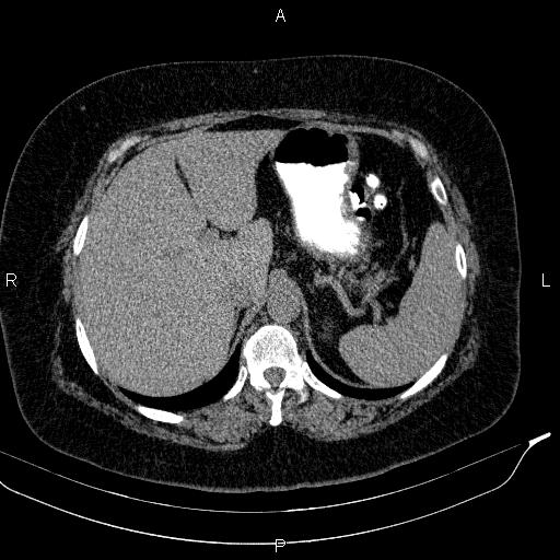File:Adrenal myelolipoma (Radiopaedia 84319-99617 Axial With oral contrast 52).jpg