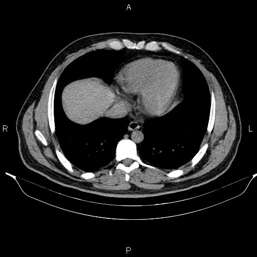 Adrenal myelolipoma (Radiopaedia 84321-99619 Axial non-contrast 11).jpg