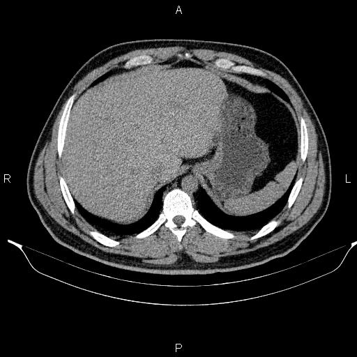 Adrenal myelolipoma (Radiopaedia 84321-99619 Axial non-contrast 20).jpg