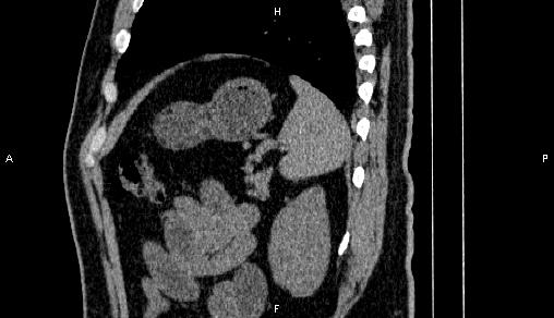 Adrenal myelolipoma (Radiopaedia 84321-99619 Sagittal non-contrast 86).jpg