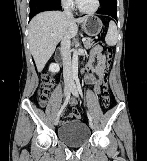 Adrenal myelolipoma (Radiopaedia 87794-104246 Coronal renal cortical phase 30).jpg