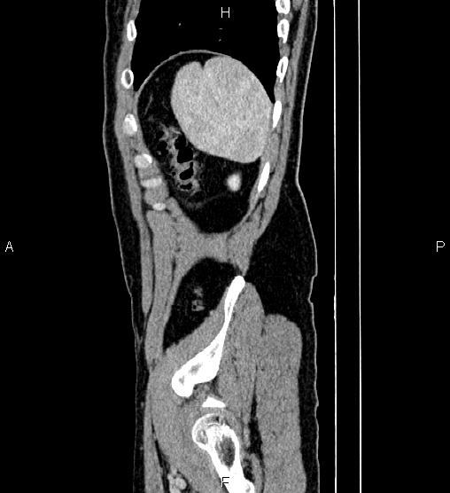 Adrenal myelolipoma (Radiopaedia 87794-104246 Sagittal renal cortical phase 84).jpg