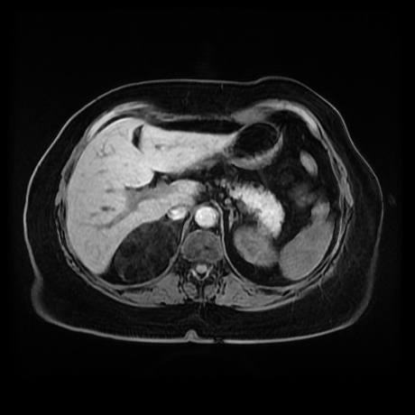 Adrenal myelolipoma - MRI (Radiopaedia 83249-97646 Axial T1 fat sat 24).jpg