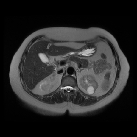 File:Adrenal myelolipoma - MRI (Radiopaedia 83249-97646 Axial T2 16).jpg