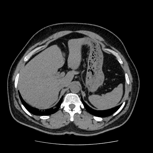 Adrenal myelolipoma and beaver tail liver (Radiopaedia 86201-102193 Axial non-contrast 101).jpg