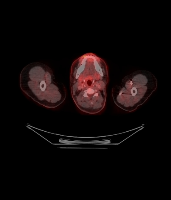 Adrenocortical carcinoma (Radiopaedia 80134-93440 ِAxial 65).jpg