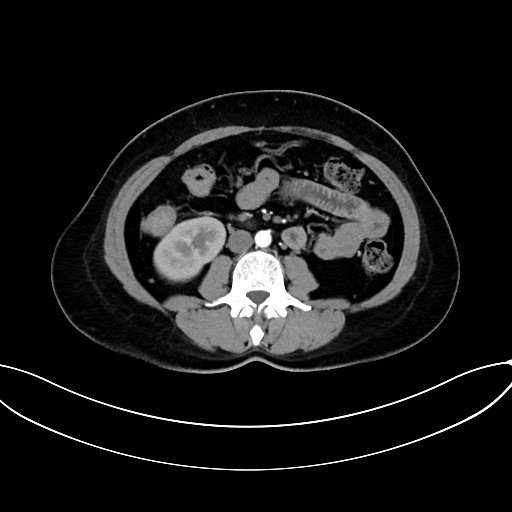 Adrenocortical carcinoma (Radiopaedia 87281-103569 Axial C+ arterial phase 46).jpg