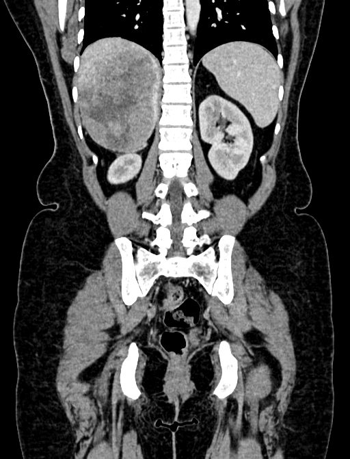 Adrenocortical carcinoma (Radiopaedia 87281-103569 Coronal C+ portal venous phase 97).jpg