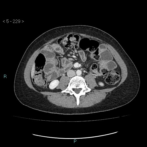 Adult transient intestinal intussusception (Radiopaedia 34853-36310 Axial C+ portal venous phase 46).jpg