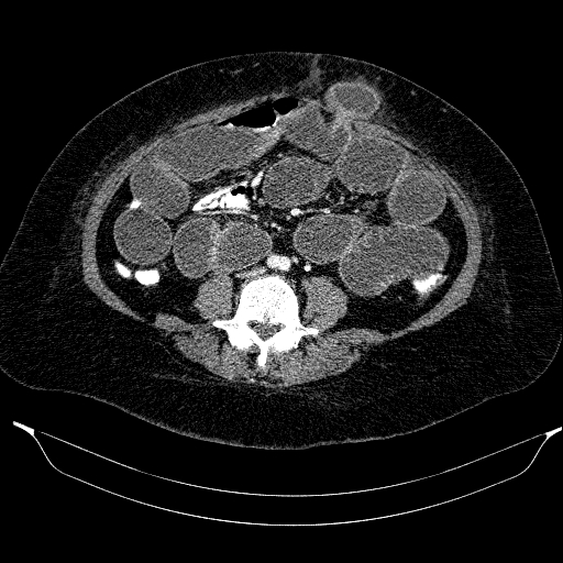 Afferent loop syndrome - secondary to incarcerated trocar site hernia (Radiopaedia 82959-97305 Axial C+ portal venous phase 144).jpg