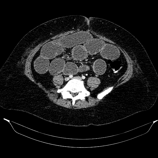 Afferent loop syndrome - secondary to incarcerated trocar site hernia (Radiopaedia 82959-97305 Axial C+ portal venous phase 160).jpg