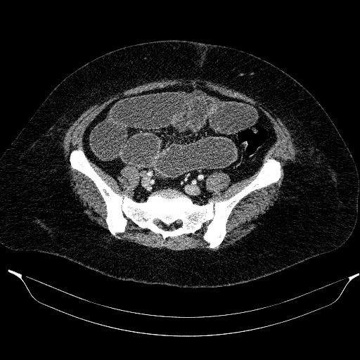 Afferent loop syndrome - secondary to incarcerated trocar site hernia (Radiopaedia 82959-97305 Axial C+ portal venous phase 188).jpg