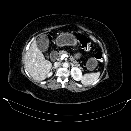 File:Afferent loop syndrome - secondary to incarcerated trocar site hernia (Radiopaedia 82959-97305 Axial C+ portal venous phase 77).jpg