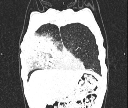 Air bronchogram in pneumonia (Radiopaedia 85719-101512 Coronal lung window 9).jpg