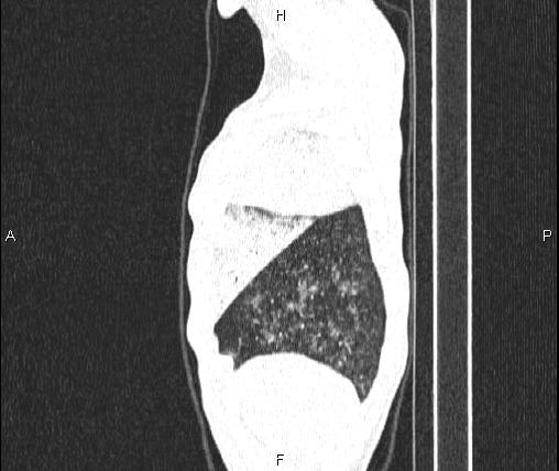 File:Air bronchogram in pneumonia (Radiopaedia 85719-101512 Sagittal lung window 11).jpg