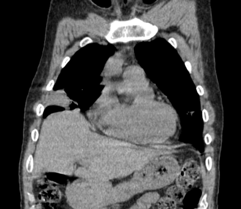 Airway foreign body in adult (Radiopaedia 85907-101779 Coronal liver window 61).jpg
