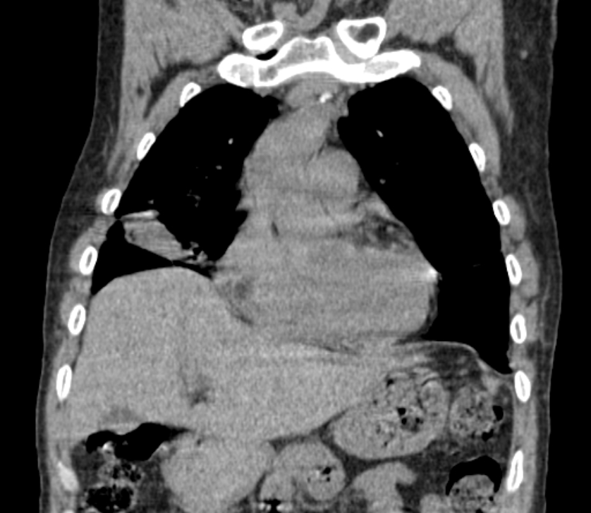 Airway foreign body in adult (Radiopaedia 85907-101779 Coronal liver window 78).jpg