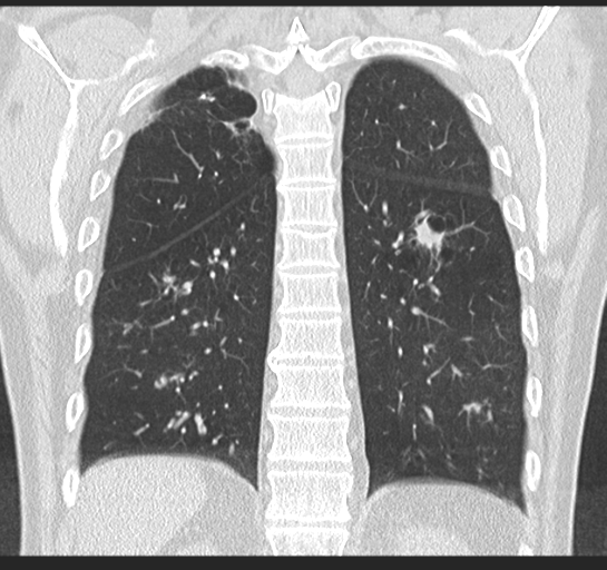 Allergic bronchopulmonary aspergillosis (Radiopaedia 44760-48571 Coronal lung window 44).png