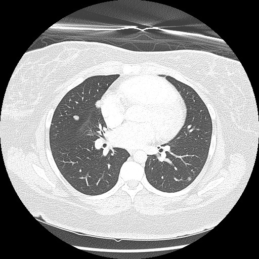 Alveolar soft part sarcoma - right leg (Radiopaedia 59432-67091 Axial lung window 59).jpg