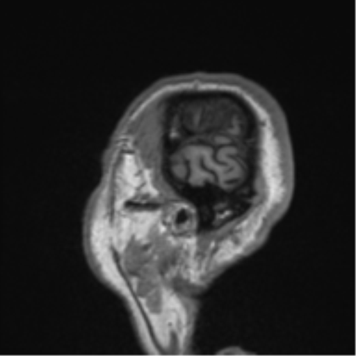 Alzheimer's disease- with Gerstmann syndrome and dressing apraxia (Radiopaedia 54882-61150 Sagittal T1 67).png