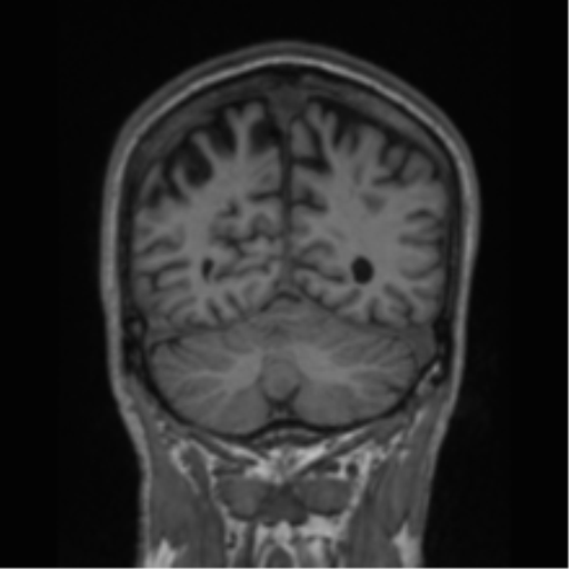 File:Alzheimer's disease- with apraxia (Radiopaedia 54763-61011 Coronal T1 28).png