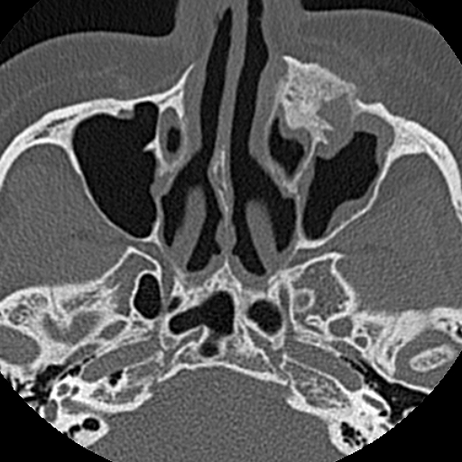 File:Ameloblastic fibro-odontoma (Radiopaedia 18843-18780 C 14).jpg