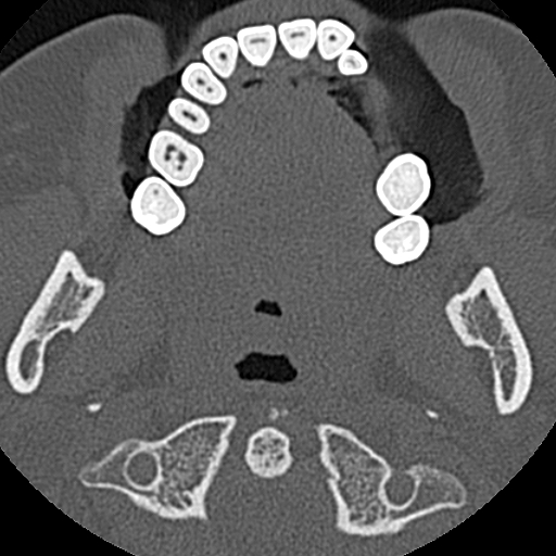 File:Ameloblastic fibro-odontoma (Radiopaedia 18843-18780 C 52).jpg