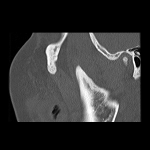 File:Ameloblastic fibro-odontoma (Radiopaedia 18843-18780 bone window 16).jpg