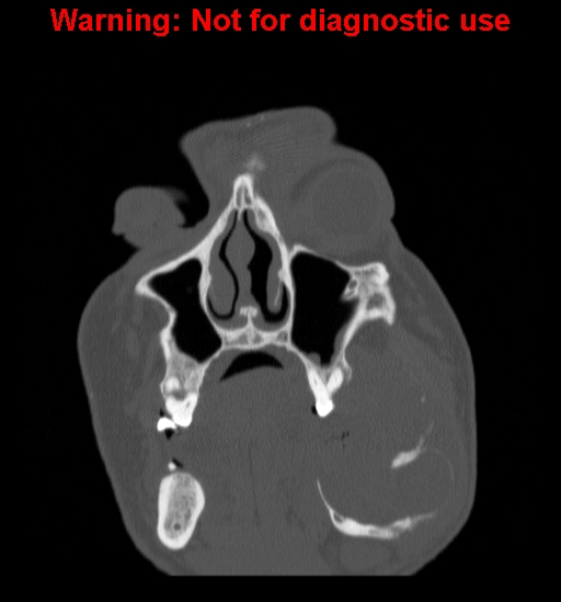 File:Ameloblastoma (Radiopaedia 13276-13280 Coronal non-contrast 5).jpg